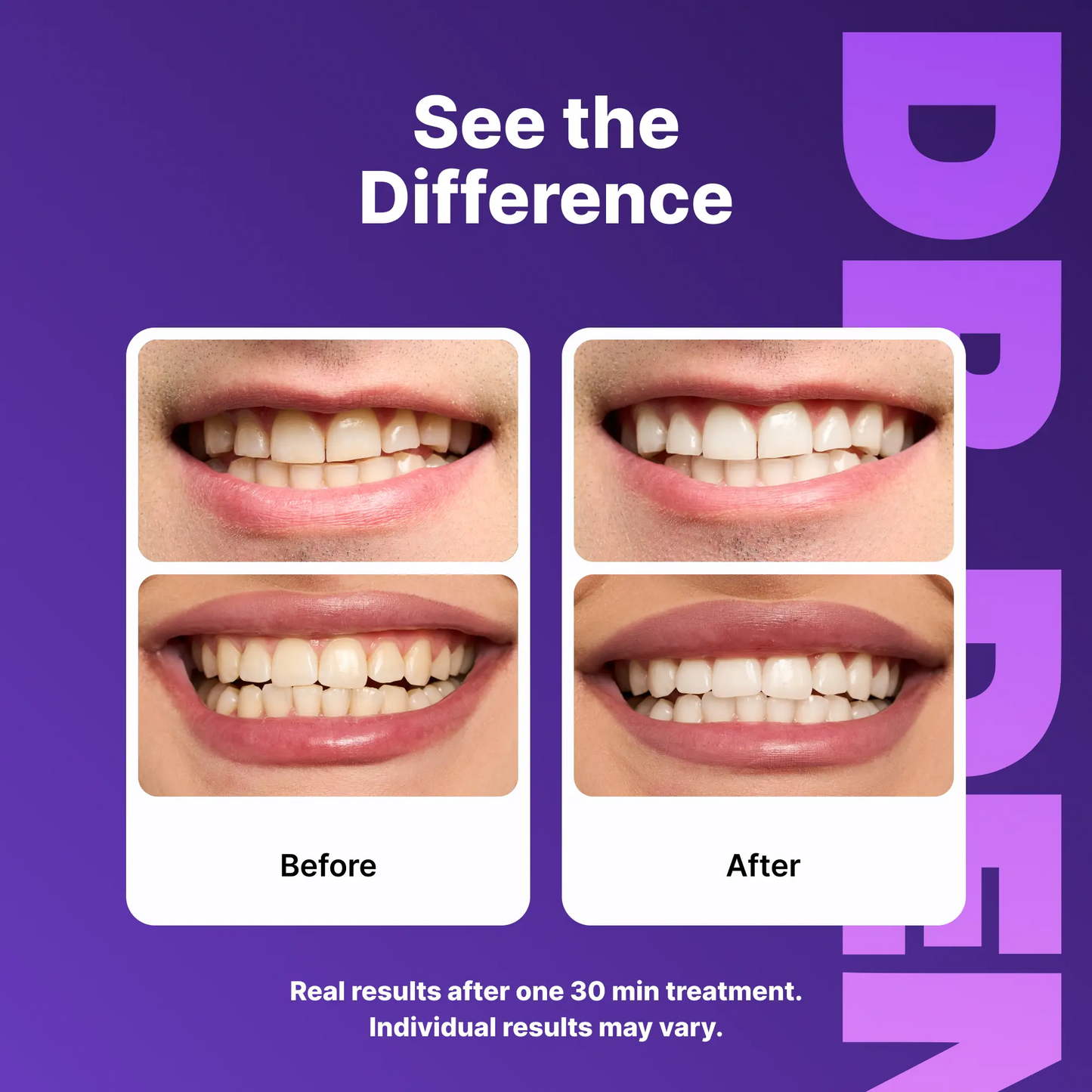 DRDENT Purple Teeth Whitening Strips