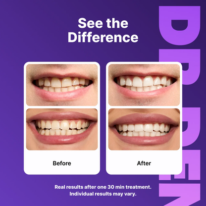 DRDENT Purple Teeth Whitening Strips
